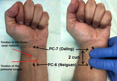 Figure 2: Localization of acupuncture points.