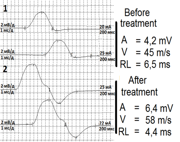 Figure 6: Dynamics of electromyography changes of right median nerve in patient with CTS after treatment by LH TENS (male, 45 years old, duration 12 years). A: Amplitude M-response, V: Velocity, RL: Residual latency.