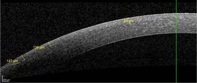 Figure 12: crosslinked cornea 1 month post-operative: traces of the demarcation line with disappearance of flap hinge hyper reflectivity.