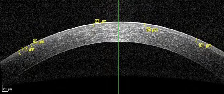 Figure 13: Non crosslinked cornea 3 months post- operative: uniform femto Lasik flap, hard to distinguish in Para central and central cornea.