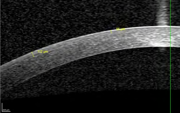 Figure 14: Non crosslinked cornea 3 months post- operative: flap edge barely visible In femto Lasik corneas.
