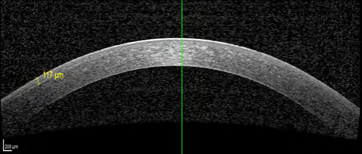 Figure 15: Non crosslinked cornea 3 months post- operative: uniform flap with hard to distinguish border at the central and Para central cornea.
