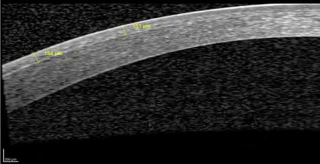 Figure 16: Crosslinked cornea 3 months post-operative: demarcation line noted at 150±10µm in the anterior stroma.