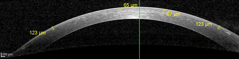 Figure 7: Non-crosslinked corneas 1 week post-operative: no demarcation line and uniform flap thickness.