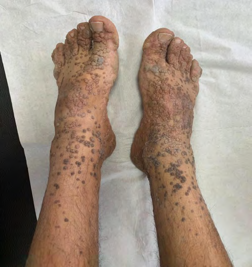 Figure 2: Multiple skin colored and brownish papules.