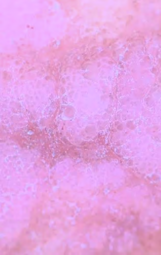 Figure 3: Dermoscopic feature: Cobblestone appearance.