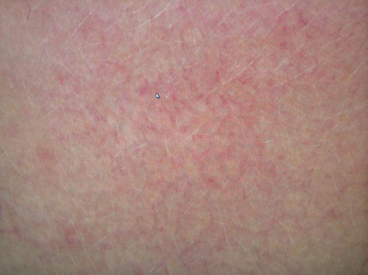 Figure 2: Representative dermoscopic analysis showing erythema, telangiectasia, and marked scales.