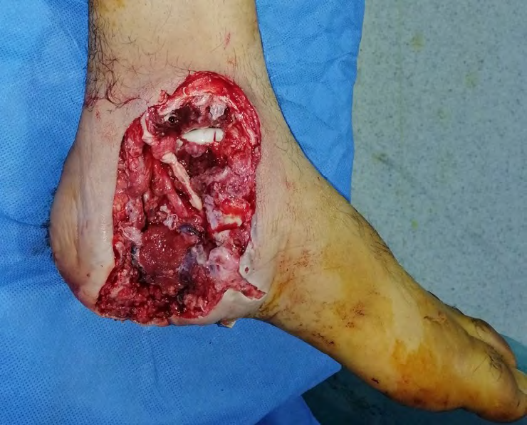 Figure 6: ** A. External supramalleolar flap drawn on the lateral aspect of the leg using the Valenti technique. B and C. removal of the fascio cutaneous flap. D. suture of the donor area to be grafted secondarily. E. Positioning of the flap to cover the joint and exposed pedicle.
