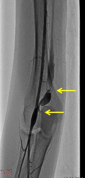 Figure 1: Left transbrachial angiogram showing justa- anastomotic steno tic lesion.