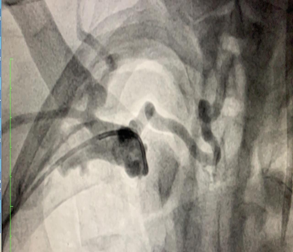 Figure 3: Occluded right brachiocephalic vein with the appearance of dilated tributaries.