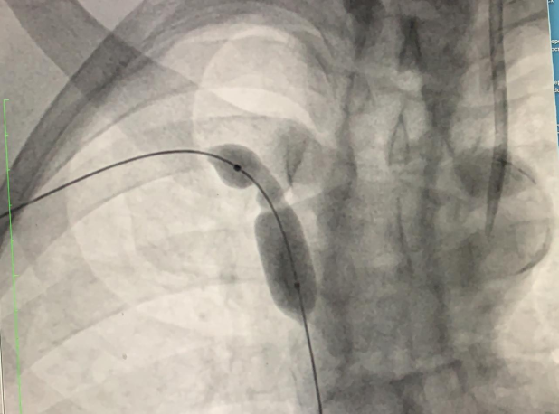 Figure 4: Balloon dilatation of the right brachiocephalic vein.