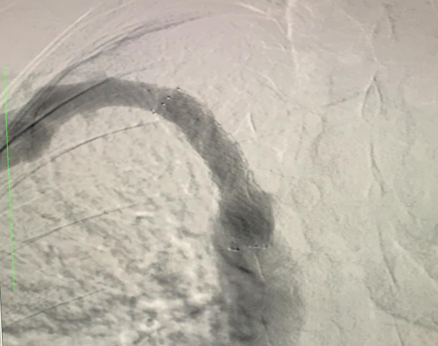 Figure 6: Completion angiogram after stent deployment showing no residual stenosis.