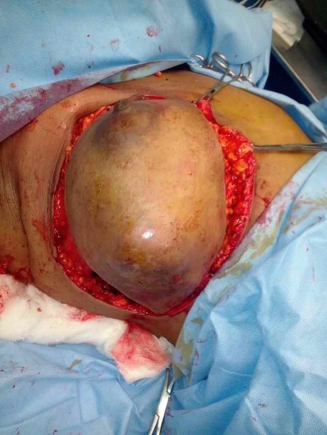 Figure 1: Image showing right breast with tumour in the outer lower quadran.