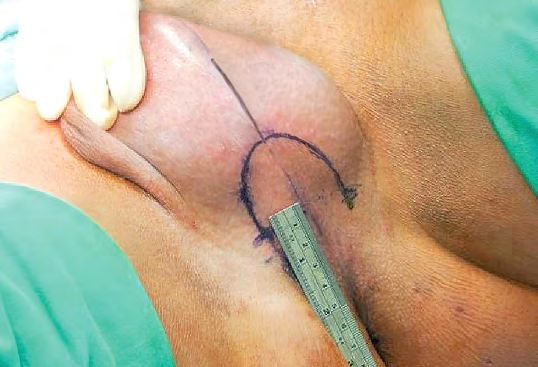 Figure 1: Inverted-Y incision at perineum.