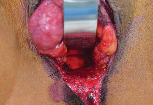 Figure 2: Neovaginal cavity with endoscopic illuminated intra-rectal light guide.