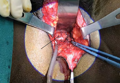 Figure 3: First landmark, Cowper’s glands are shown posterolateral to the inferior border of the prostate glands.