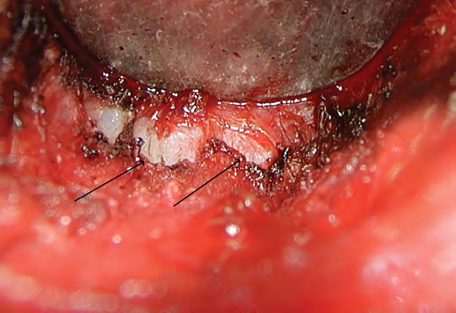 Figure 4: Second landmark, the prostaticovesicular fascia at the inferior border of prostate gland.