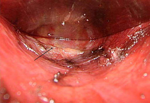 Figure 5: Third landmark, dens fibrous tissue at the peritoneal reflection.