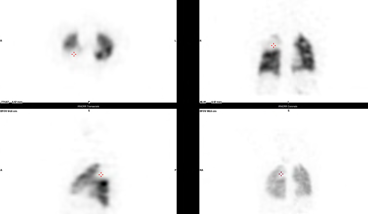 Figure 2: SPECT pulmonary perfusion imaging: The posterior segments of the upper lobe of the right lung pulmonary perfusion defects.