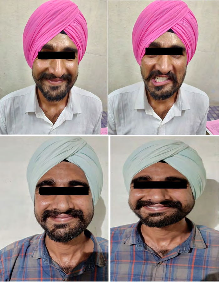 Figure 2: Pre-operative (above) and Post-operative picture after 4 weeks (below) showing Zygomaticus type smile (Left) and near normal denture smile (right).