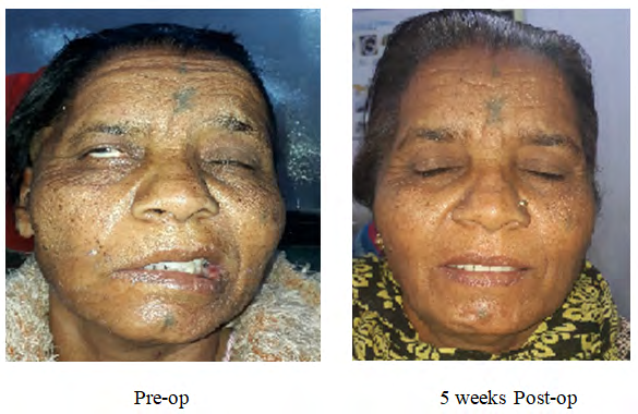 Figure 4: 1: Lesion at 1st genu.