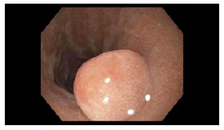 Figure 1: Upper Gastrointestinal endoscopy shows a 10mm pedunculated polyp in the duodenal bulb.