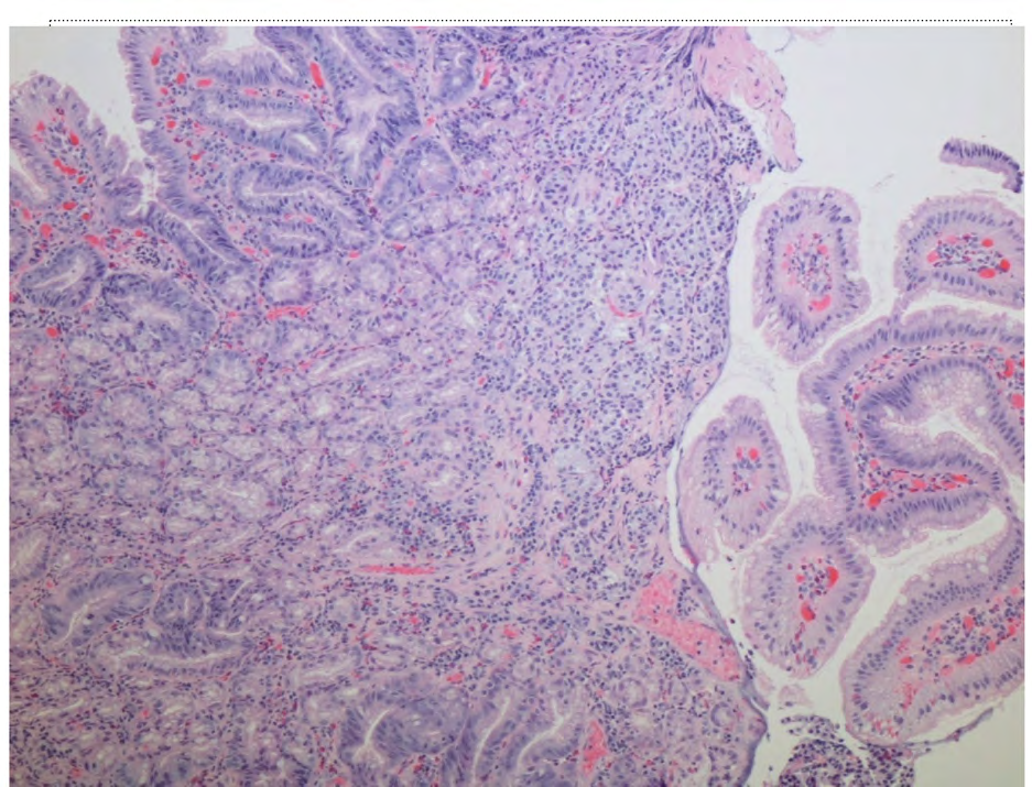 Figure 2: Magnification 100x. Duodenal polyp with aggregates of neuroendocrine cells within the lamina propria.