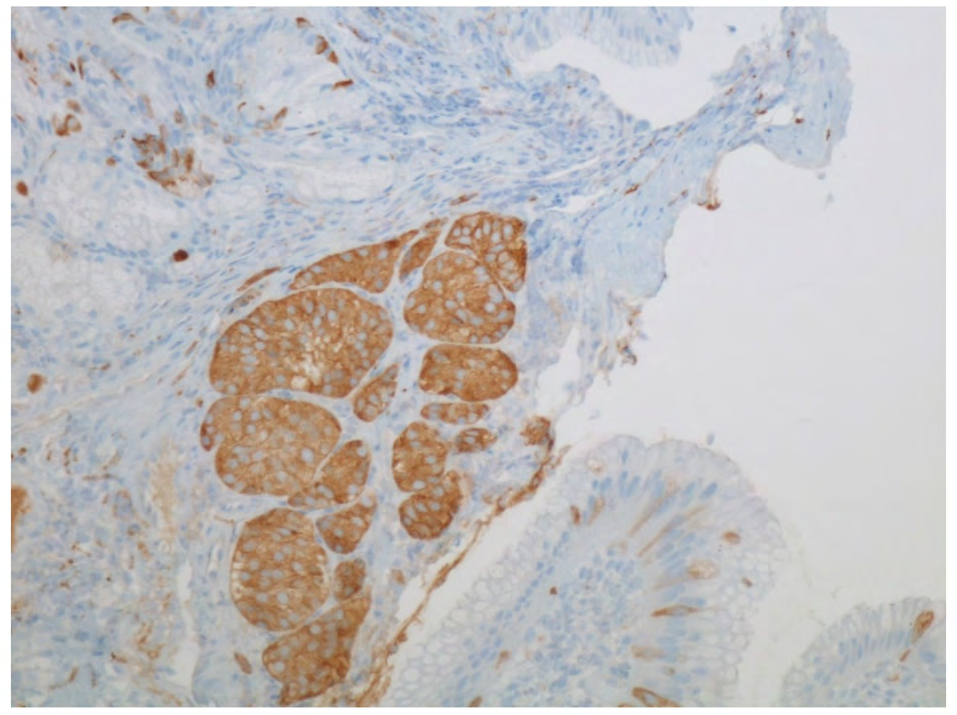 Figure 4: Synaptophysin Magnification 200. Neuroendocrine cells positive for synaptophysin.