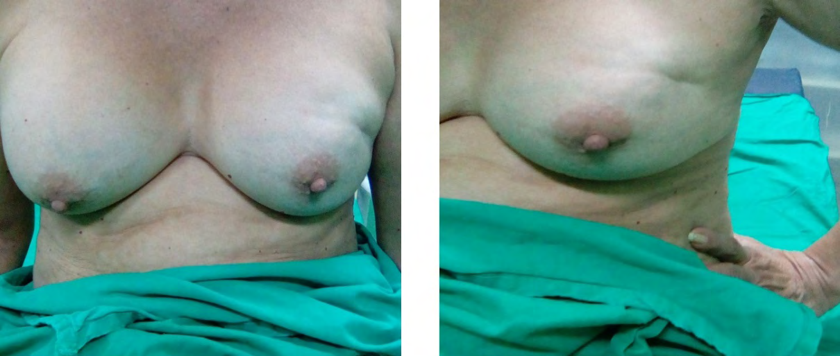 Figure 1: Patient with a breast prosthesis operated 10 years ago who presented a 2.5 cm tumor in the upper external quadrant of the left breast that retracts the skin. A. Front view. B. Oblique view.