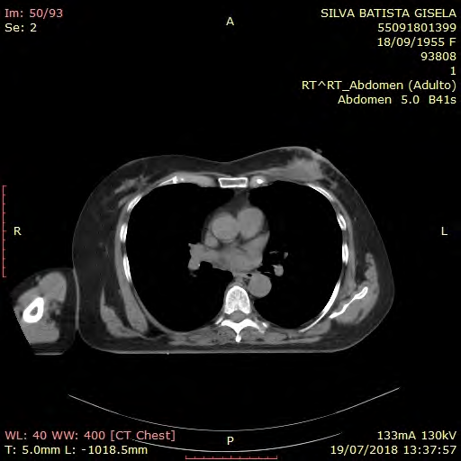 Figure 3: Simple computed tomography of the chest showing a tumor in the upper external quadrant of the left breast with metastatic left axillaries lymphadenopathy and intracapsular rupture of the left breast prosthesis.