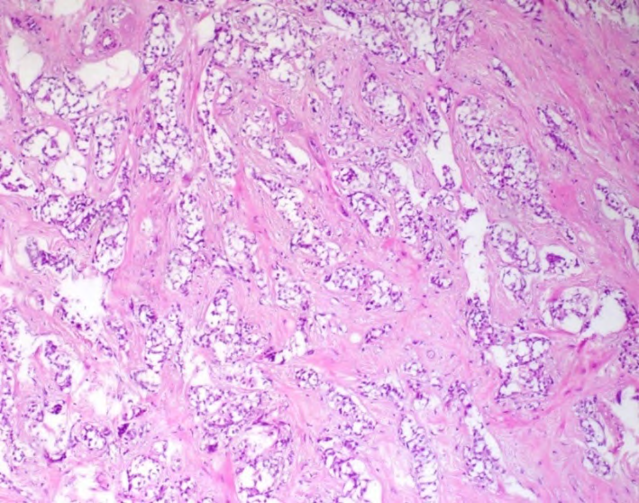 Figure 5: Paraffin biopsy of infiltrating ductal carcinoma.