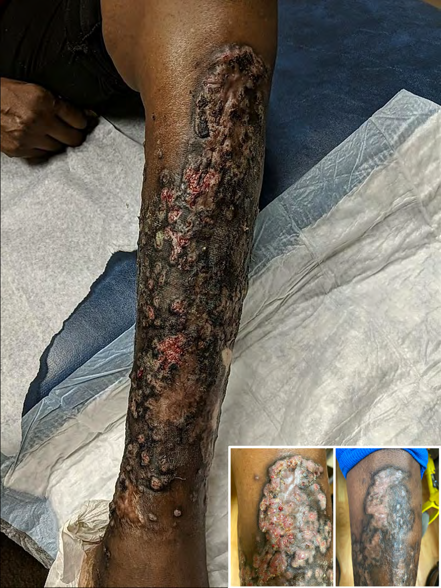 Figure 1: Deep cutaneous Scedosporium infection at presentation to our clinic, 9-months after initial local dermatologist visit. Verrucous hyperpigmented papules coalescing into fluctuant plaques overlying the left lower extremity. Patient’s left lower extremity before treatment (left inset) and five months after treatment with voriconazole (right inset).