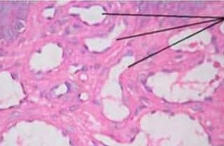 Figure 2: Benign lymphangioendothelioma delineating irregular lymphatic channels layered with plump endothelial cells surrounded by a collagenous stroma [10].