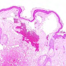 Figure 4: Benign lymphangioendothelioma depicting irregular lymphatic channels accumulated within dermal tissue with a coating of “hobnail” endothelium and a superimposed hyperkeratotic epidermis [12].