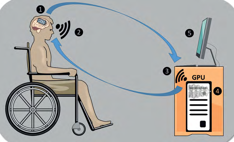 Figure 1: An example Illustration of a brain computer interface product that contain 1. Implanted array of electrodes to read brain signals and 2. Transition of that signals information into 3. A receiver machine such as computer 4. Which has ability to read brain signals data 5. To apply it in control process for a specific activity [5].