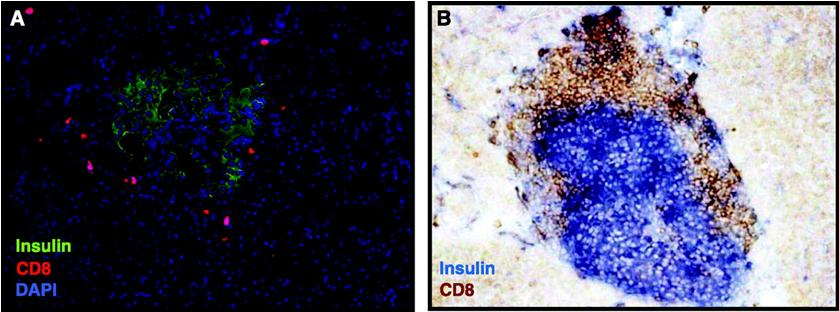 Figure 4: Courtesy ref no13-The degree of pancreatic infiltration in T1D patients is limited compared with the insulitis in NOD mice around diabetes onset. Infiltration in or around the islets of Langerhans in the pancreas comprises CD8 T cells, CD4 T cells, but also B cells, macrophages and very few dendritic cells. In this respect, i.e., the type of cell infiltrating the islets, pancreatic section from human and NOD mice correspond. But the degree to which the pancreas and islets are inflamed, i.e., the number of infiltrating cells that can be found, is much more limited in humans than in NOD mice. A: typical degree of infiltration in recent-onset type 1 diabetic pancreas in humans. Staining of human pancreas sections for insulin (in green) and CD8 T cells (in red) indicates that only low levels of CD8 T cells can be seen in the proximity of the islets. A similar low degree of infiltration is observed for CD4 T cells and B cells in pancreatic sections of T1D patients (not shown). More information can be found in Reference 99. B: typical level of inflammation around diabetes onset in female NOD mice. Staining for insulin (in blue) and CD8 (in brown-red) shows a severe degree of infiltration by CD8 T cells in the islets. The type and degree of infiltration of CD4 T cells at this time point are usually similar (not shown).