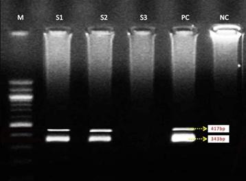Figure 3: Liver function profiles of Hepatitis C virus manifestations. The total bilirubin observed was 70%, serum glutamine oxalo transaminase (SGOT) (60%), serum glutamate pyruvic transaminase (SGPT) (60%), alkaline phosphatase (55%) and albumin (49%). The liver parameters especially the total bilirubin and enzymatic parameters SGOT, and SGPT were found to be significantly elevated in the HCV infected patients. RNA of the HCV genotype isolated from the ELISA positive plasma samples were amplified with RT-PCR followed by nested PCR. There were 41 HCV ELISA positive cases which were also PCR positive and in these cases, the amplicon of HCV core protein region were amplified in the 5’ prime untranslated regions of the genome. The amplicons were profiled with the agarose gel electrophoresis as shown in Figure 4.