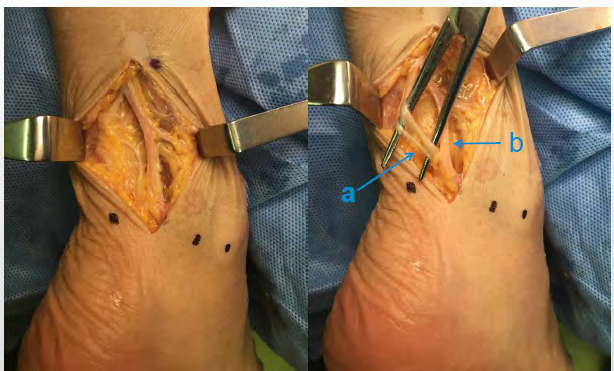 Figure 2: Sural nerve and small saphenous vein. a: sural nerve b: small saphenous vein.