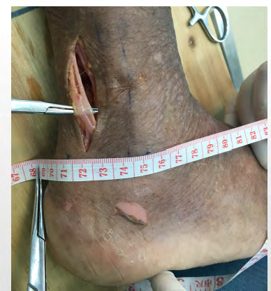 Figure 3: Average distance from the tip of the lateral malleolus to midpoint of sural nerve and small saphenous vein.
