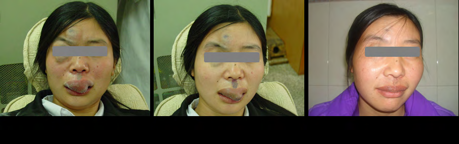 Figure 1: Pingyangmycin Combined with Nd:YAG laser treatment cured venous malformation.