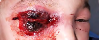Figure 1: Maculopapular exanthema Periorbital.