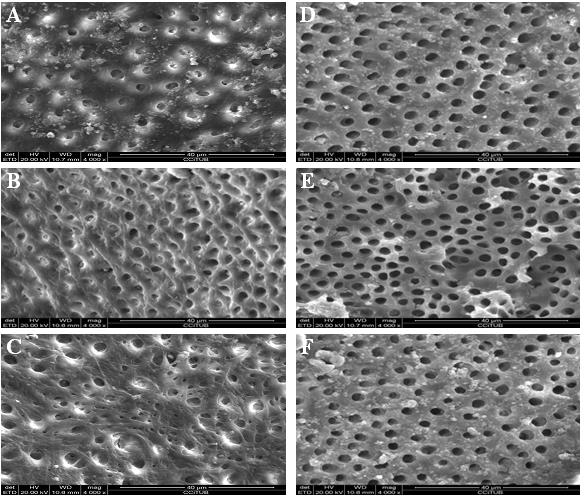 Figure 2: Scanning electron microscope photomicrographs (x4000 magnification). 2.25% peracetic acid solution-irrigated group: (A) Coronal third. (B) Middle third. (C) Apical third. 17% EDTA solution-irrigated group: (D) Coronal third. (E) Middle third. (F) Apical third.