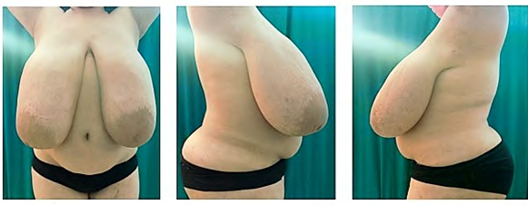 Figure 2: Gestational gigatiomastia. Preoperative Period. A: Front View. B: Right side view C: Left side view COVID-19 rapid test paraclinical examinations were performed: negative, complete blood count within normal parameters. Post-treatment prolactin dosing was performed which was normal. With all these elements, gestational gigantomastia is diagnosed and surgical treatment is proposed. The technique of choice is the Thorek reduction mastoplasty, which consists of radical resection of both breasts with a lower pedicle flap and a free ANC graft.