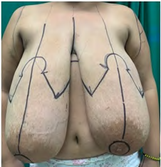 Figure 3: Preoperative planning front view.