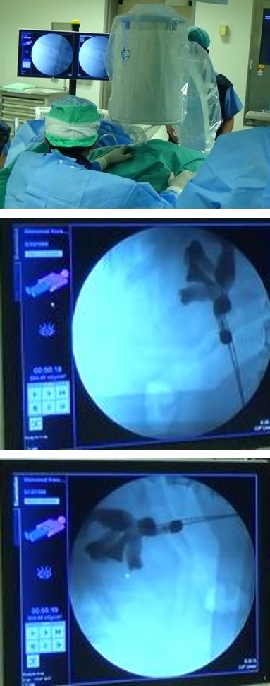 Figure 1: Vertical position of fluoroscopy.