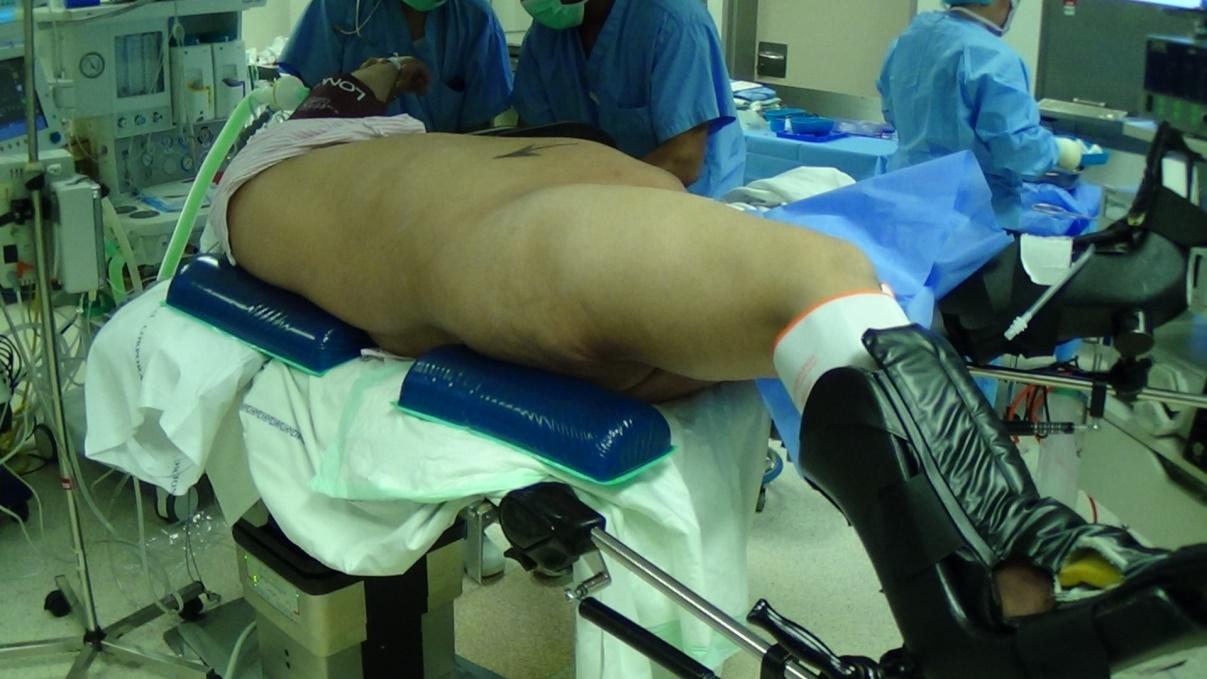 Figure 4: Prone position after the insertion of ureteric catheter.