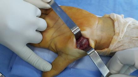Figure 1: Images in hypersignal in T2 after injection of gadolenium.