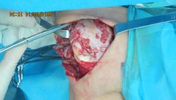 Figure 2: Outward turning the shoulder joint. Than expose humerus head fully, use sharp osteotome to remove the osteophyte around the head of the humerus, drilling on the defect of humerus head cartilage by kirschner wire to reduce the pressure.