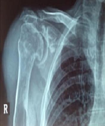 Figure 4: Re-examining the X-ray films After 6 months.