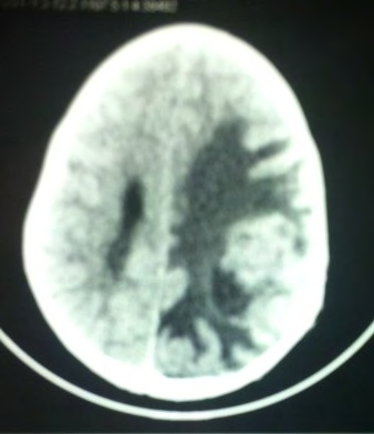 Figure 2: Post operatives brain MRI at 03 months postoperatively, in T1 sequence with gadolinium.